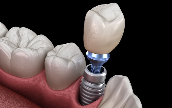 How Long Will Dental Implants Last