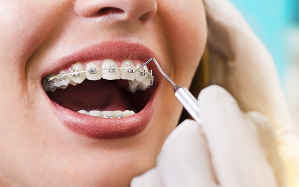 Why Might Orthodontics Be Needed