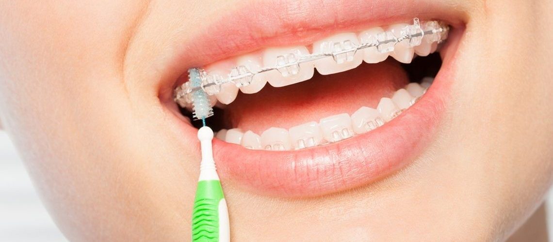 Oral Hygiene Tips With Orthodontics – Part 1 Of 2